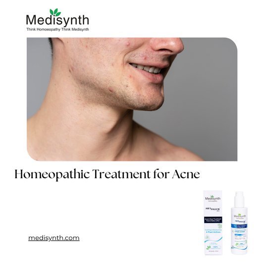 Homeopathic Treatment for Acne