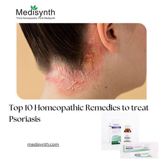 Top 10 Homeopathic Remedies to treat Psoriasis
