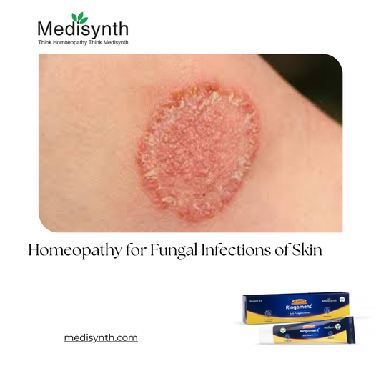 Homeopathy for Fungal Infections of Skin